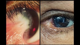 Pterygium Surgery Repair Dry Eye  Dr Toyos lectures on how he repaired the worst Pterygium ever [upl. by Drahser]