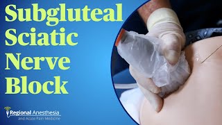 Subgluteal Sciatic Nerve Block [upl. by Normandy883]