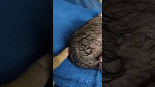 Medical Education Video Neonatology Subgaleal bleed in newborn [upl. by Phillida]