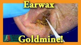 Earwax GOLDMINE  Auburn Medical Group [upl. by Dona]