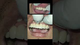 Fixed teeth  Bridge Replacing missing teeth Nakkali dat PFM Zirconia Bridge Dentist in Nepal [upl. by Dwight]