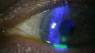 Aril Amniotic Membrane Transplant for Recurrent Corneal ErosionAbrasion Heal Eyes with less scars [upl. by Narrad]