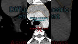 Thymic Hyperplasia vs Thymoma on Imaging [upl. by Ahsats]