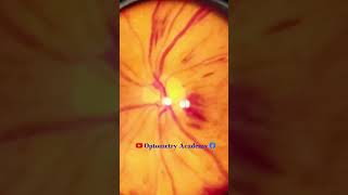 Diabetic retinopathy  Hemorrhages  proliferative diabetic retinopathy PDR  Short Video 184 [upl. by Eselehs]