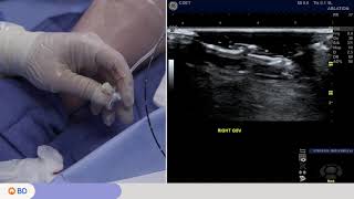 Venclose™ RF Ablation Catheter Procedure Video [upl. by Oloapnaig]