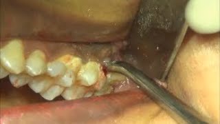 Coupland elevator to remove upper maxillary 3rd molar tooth [upl. by Nadya]