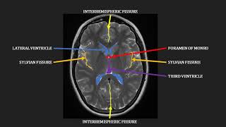 Introduction to MRI of the brain [upl. by Eenimod]