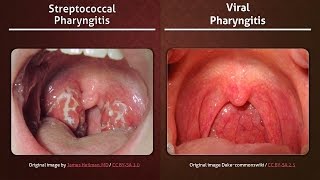 Streptococcal vs Viral Pharyngitis [upl. by Brucie]