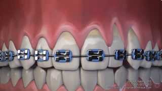 Gum Recession After Wearing Braces Can Now Be Treated Without Gum Grafting Surgery [upl. by Cantlon]