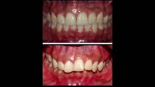 Brackets antes y después orthodontics dentist dentista smile braces beforeandafter [upl. by Nahtad]