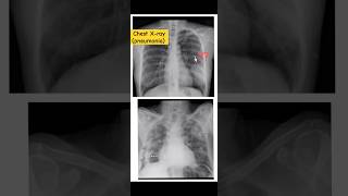 Xray ChestPneumonia 🩻signampsymptomscomplicationsradiologyytshorts [upl. by Kassia]