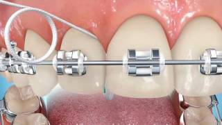 Dentist Reviews Superfloss by Oral B The BEST FLOSS For Braces Bridges amp Permanent Retainers [upl. by Herrington]