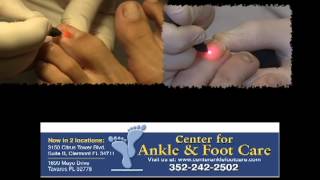 PinPointe Laser for Toenail Fungus [upl. by Mariel]