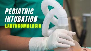 Pediatric Intubation  With Laryngomalacia [upl. by Ahsenwahs]