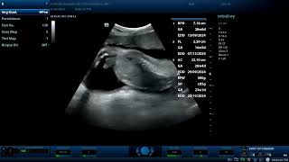 Achondroplasia ultrasound findings Diagnostic ultrasound cases [upl. by Anivek]