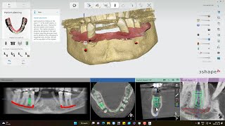 Trying 3Shape Implant Studio [upl. by Adlev]