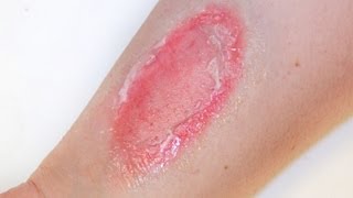 FX MAKEUP SERIES Second Degree Burns [upl. by Ahsilyt]