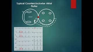 Atrial Flutter Mechanism and Diagnosis  Dr Emad effat [upl. by Nnylorac]