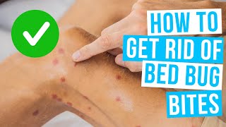 How to GET RID OF BED BUG BITES overnight [upl. by Iran]