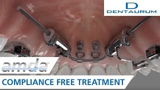 amda®  compliancefree treatment advanced molar distalization appliance [upl. by Nilahs]