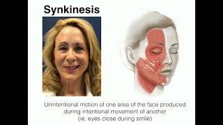 What is Facial Synkinesis [upl. by Gerfen]