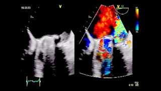 ROCKING MOTION  Major dehiscence of infected mitral valve prosthesis [upl. by Lim]