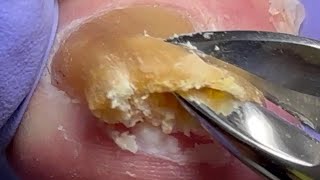 Trim onychomycosis super thick nails very large nails【Doctor Liu Pedicure】 [upl. by Maryellen692]