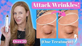 Real Results Wrinkle Reduction Using the Snow Fibroblast Plasma Pen  Pros amp Cons  Before amp After [upl. by Neiv]