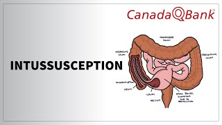 Intussusception [upl. by Einiffit]