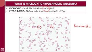 Hematology  1  U7L1  Introduction to microcytic hypochromic anaemias [upl. by Salome]