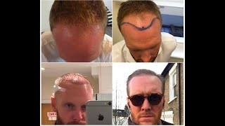 Joe Ottaway Stylist to the Stars Hair Transplant Transformation [upl. by Carissa]