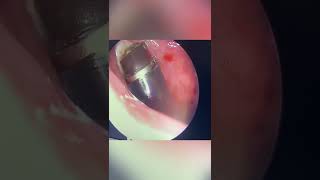 Removing Adenoids without bleeding or pain  Coblation Adenoidectomy [upl. by Arayt113]