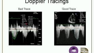 Optimizing Your Echo Images amp Doppler Evaluations webcast [upl. by Sirraf364]