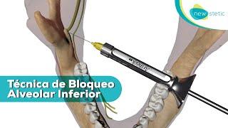 Técnica de bloqueo alveolar inferior 💉 🦷  New Stetic SA [upl. by Hannavas]