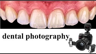 dental photography [upl. by Imefulo307]