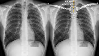 Chest Xray Anatomy  Read Chest Xray  Diagnosis Chest Xray [upl. by Smallman703]