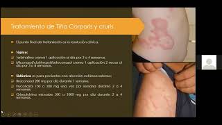 Micosis superficiales Dermatofitos [upl. by Neddra]