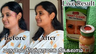 Wart Remover Honest Review in Tamil  வலியே இல்லாமல் மருவை நிரந்தரமாக நீக்கலாம்  Wart Remover Tamil [upl. by Aimet]