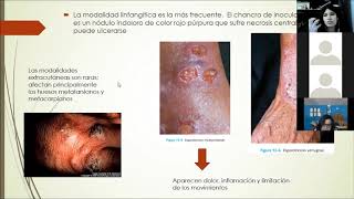 Micosis subcutaneas [upl. by Shifra]