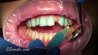 porcelain dental veneer bridge and veneers cosmetic dentistry before and after [upl. by Adnarram983]