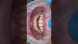 Only Four minimal preparation Porcelain veneers [upl. by Anifad429]