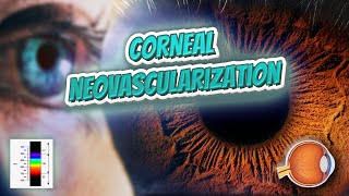 Corneal neovascularization  Your EYEBALLS  EYNTK 👁️👁️💉😳💊🔊💯✅ [upl. by Guerin280]