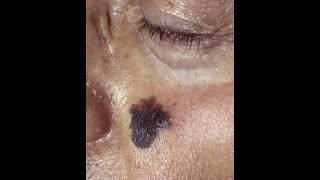 Squamous Cell Carcinoma and Lentigo Maligna Melanoma plus the precancerous conditions [upl. by Harms729]