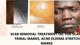 SCAR REMOVAL OIL TREATMENT for Scars Tribal Mark Acne Even skin tone Eczema stretch marks [upl. by Etnoek460]