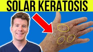 Doctor explains Actinic Solar Keratosis  Sun damaged skin  causes symptoms and treatment [upl. by Kilbride788]