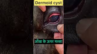 Dermoid cyst l Dr umar khan [upl. by Barrada208]