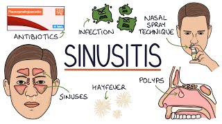 Understanding Sinusitis [upl. by Dat]