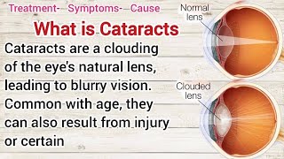 What is cataractsTreatmentSymptoms amp Causes [upl. by Nael]