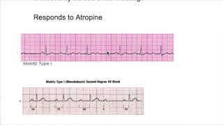 1st 2nd 3rd degreeStokes Adam Attack heart block [upl. by Elysee]