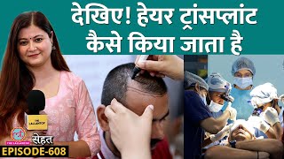 Hair Transplant के बाद बाल कभी नहीं गिरते Baldness यानी गंजापन ठीक हो जाता है  Sehat 608 [upl. by Auburta]